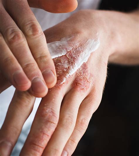 Ichthyosis Vulgaris: Causes, Symptoms, Diagnosis, & Treatment