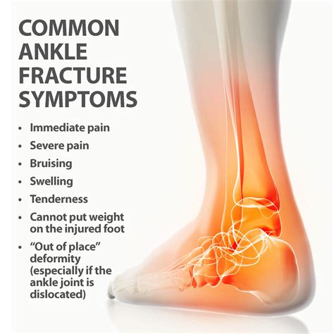 Ankle Fractures Broken Ankle | Florida Orthopaedic Institute