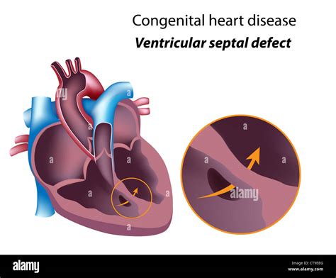 Enfermedad del corazón congénita: defecto septal ventricular Fotografía de stock - Alamy
