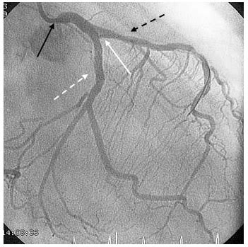 Left Main Coronary Artery Stenosis ( LMCA )