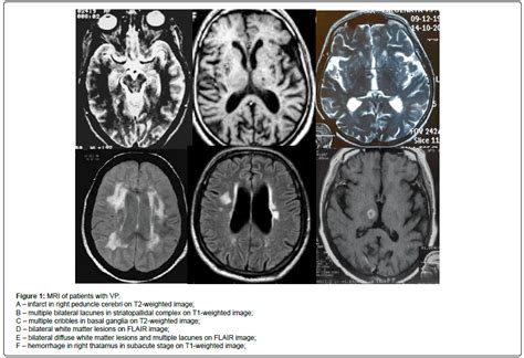 Journal of Alzheimers Disease & Parkinsonism - Cognitive Impairment and ...