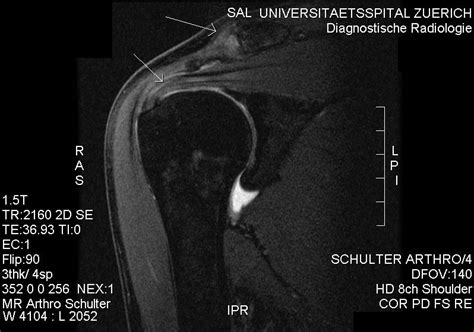 Weight training and shoulder pain: subacromial impingement syndrome - Toronto Physiotherapy