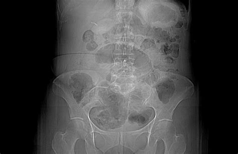 Post Gad: Closed Loop Obstruction