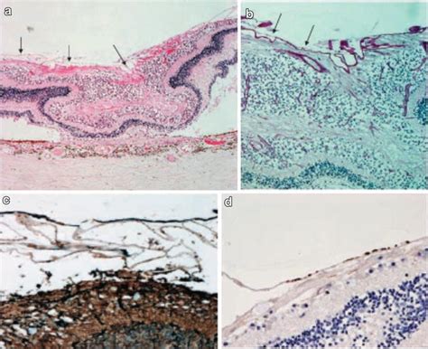 Cellophane Maculopathy | SpringerLink