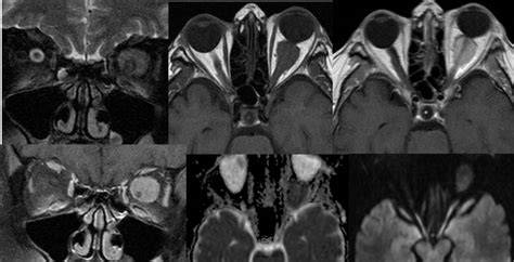 optic nerve sheath meningioma