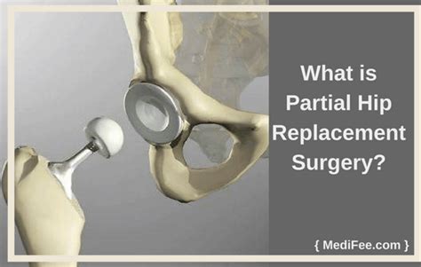 Partial Hip Replacement Surgery: Methods, Risks & Precautions