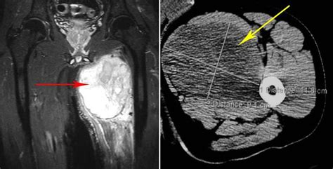 Soft Tissue Sarcomas - OrthoInfo - AAOS