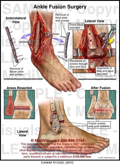 Ankle Fusion Surgery MediVisuals Medical Illustration