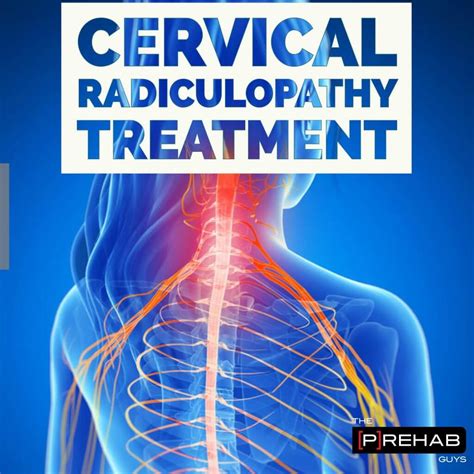 Cervical Radiculopathy Treatment And Assessment | The Prehab Guys