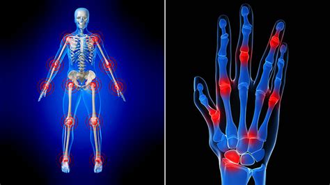 Case Studies #13 -High Dose Vitamin D3 CURES Rheumatoid Arthritis – Jeff T Bowles