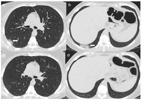 Diagnostics | Free Full-Text | Chest CT Findings after 4 Months from ...