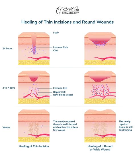 How To Heal A Cauterized Wound Fast - Heal Info