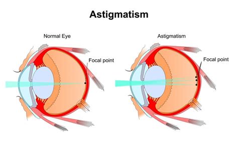 What Are the Best Contact Lenses for Astigmatism?