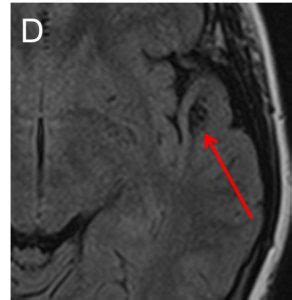 Neuroglial cyst – Radiology Cases