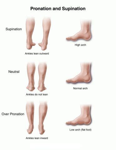 Foot Dysfunction: Overpronation and Oversupination Lead to Chronic Pain - Los Angeles, West ...