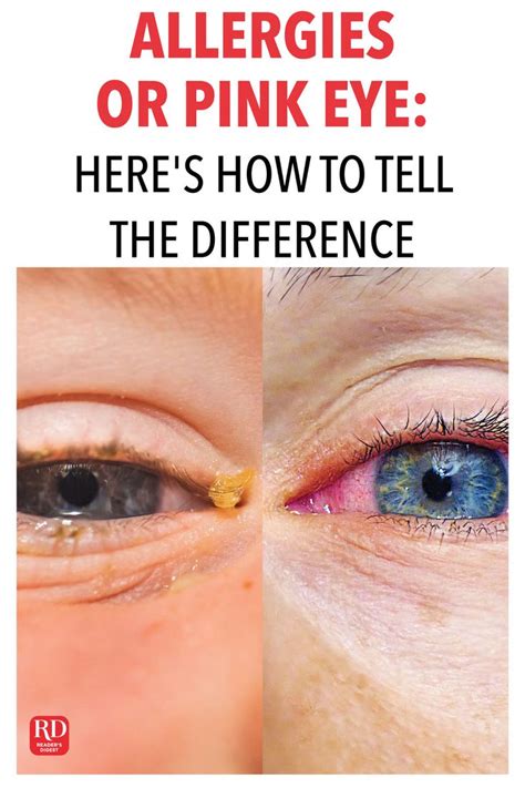 Allergies or Pink Eye: Here's How to Tell the Difference in 2020 | Allergy eyes