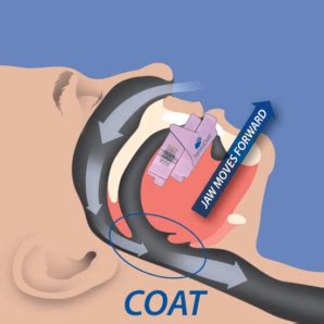 How Does an Oral Sleep Appliance or Dental Device Work to Treat Sleep ...