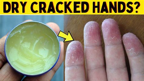 How To Fix Dry Hands Overnight at Amanda Dukes blog