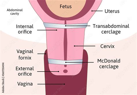 Transabdominal cerclage tightening of cervix opening during pregnancy ...