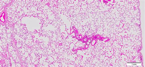 Pathology Outlines - Emphysema