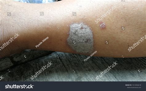 9,157 Fungal Skin Infections Images, Stock Photos & Vectors | Shutterstock