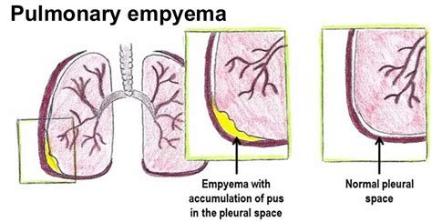 Empyema, lung empyema, causes, symptoms, diagnosis and treatment