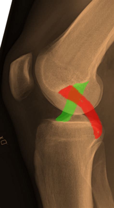 Posterior And Anterior Cruciate Ligament