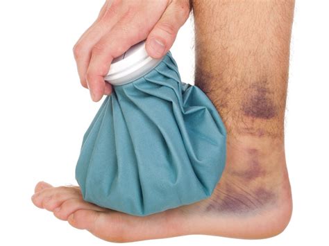 Tips for bruise treatment - Sir Health