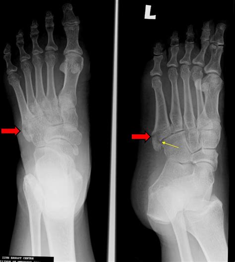 Pseudo-Jones fracture – Radiology Cases