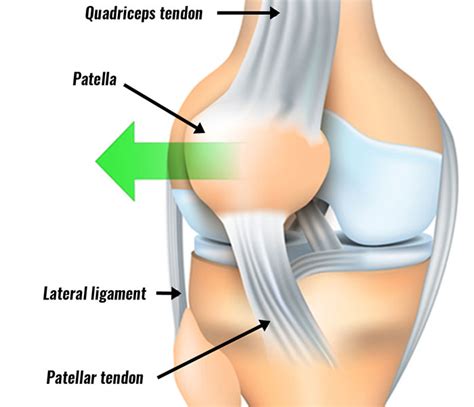 Patella Dislocation - Symptoms, Causes, Treatment and Rehabilitation