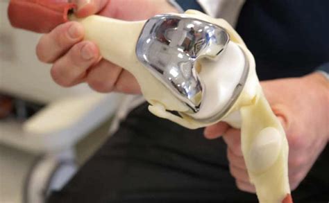 robotic knee replacement – Palmetto Bone & Joint Blog