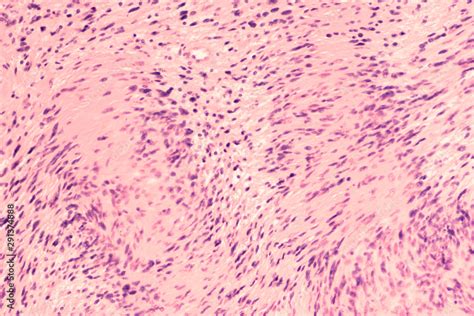 Photomicrograph of a schwannoma, a benign soft tissue tumor of peripheral nerve sheath, with ...