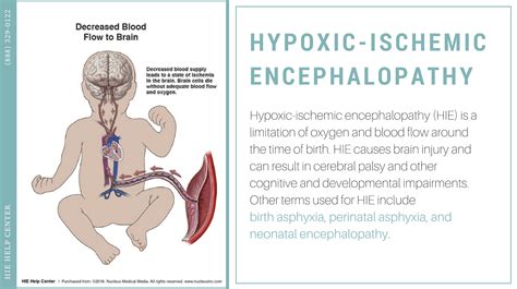 Hypoxic-Ischemic Encephalopathy - Infographics and Images