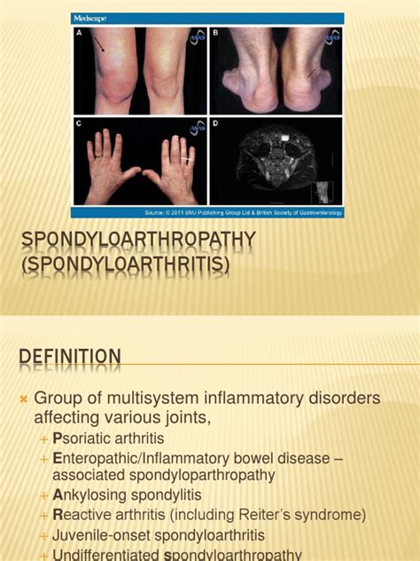 Spondyloarthropathy (Spondyloarthritis)