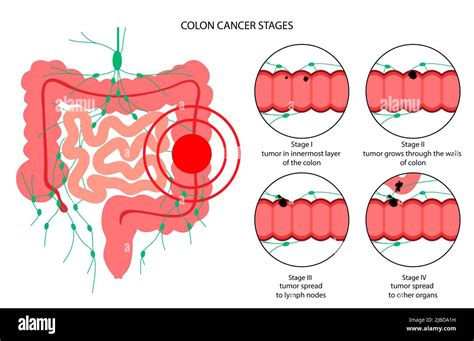 Colon cancer stages, illustration Stock Photo - Alamy