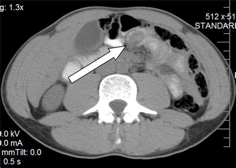 CT Abdomen/Pelvis with oral contrast. | Download Scientific Diagram