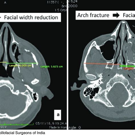 10 Zing's classification of ZMC fractures. (a) arch only (Type A1), (b)... | Download Scientific ...