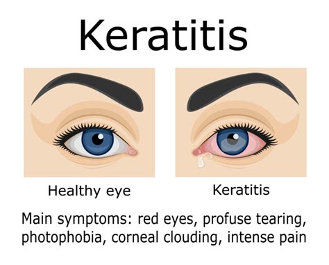 Keratitis: Causes and Treatments | Fort Lauderdale Eye Institute