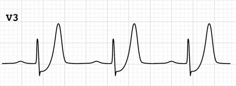 De Winter T Wave • LITFL • ECG Library Diagnosis