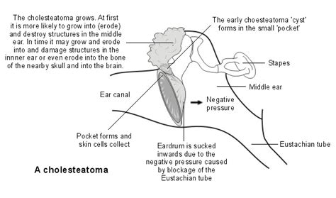 Cholesteatoma Symptoms, Causes, Diagnosis & Best Treatment