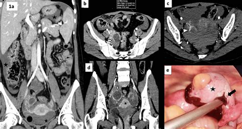 Cureus | Posttraumatic Corpus Luteal Cyst Rupture: A Diagnostic Enigma ...