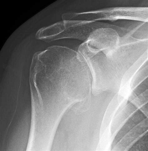 Shoulder Arthritis / Rotator Cuff Tears: causes of shoulder pain: How bad is the shoulder ...