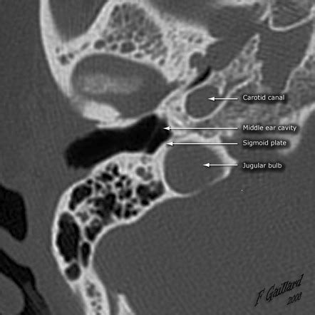 high riding jugular bulb | Radiology Reference Article | Radiopaedia.org