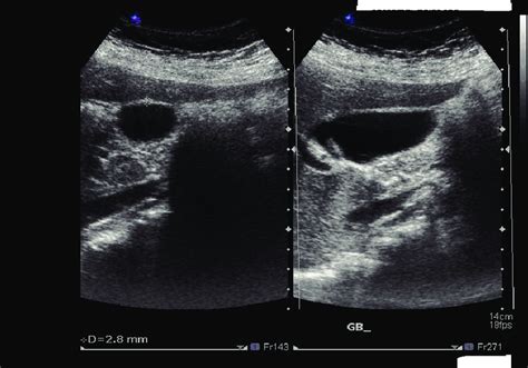 Abdominal U/S showing normal thickness of gallbladder wall. | Download Scientific Diagram