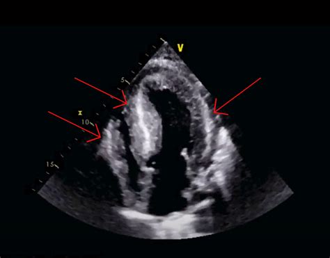 Cureus Suspecting Cardiac Amyloidosis In Congestive Heart Failure | My ...