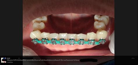 Fake braces: The result. : r/Dentistry