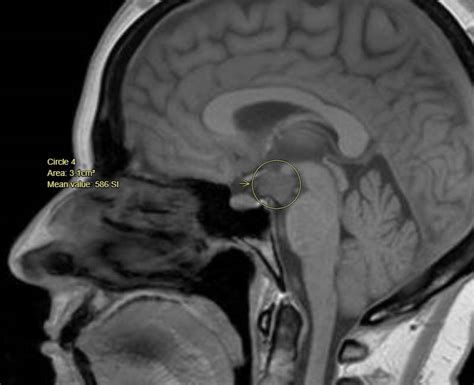 Hypothalamic Hamartoma: Symptoms, Treatment & Prognosis