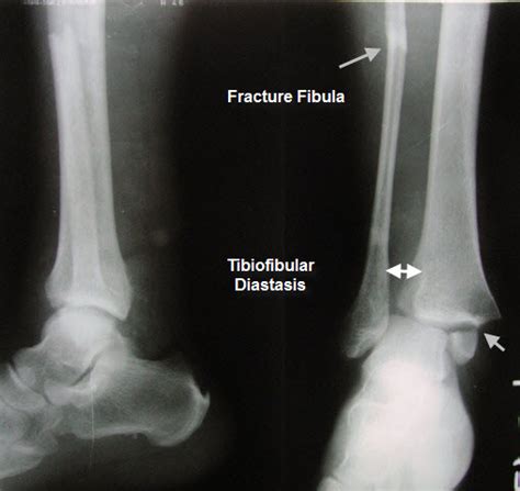 High Ankle Sprains or Syndesmotic Sprains | Bone and Spine