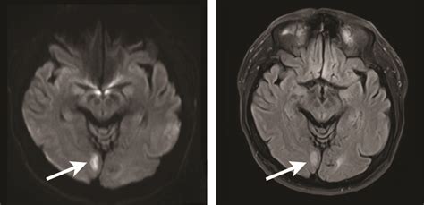 Sudden onset homonymous quadrantanopia | The BMJ