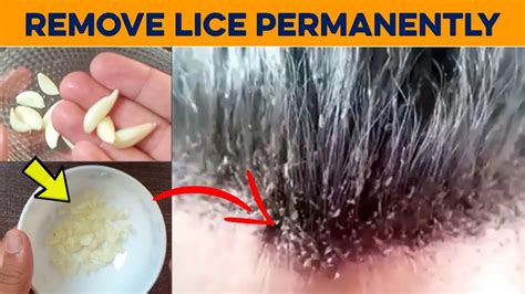 How to Get Rid of Lice Permanently in 1 Hour - Home Remedies to Get Rid ...